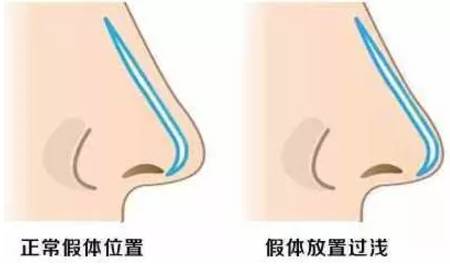 那么就可能会发生这种情况如果植入太浅,假体材料雕琢得过长但要是