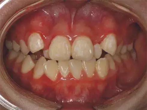 家长必看:孩子15岁前必须处理的11种畸形牙齿