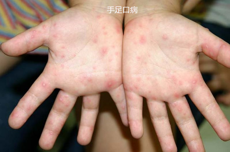 比如麻疹,水痘,手足口病,猩红热,川崎病,风疹等等,都是发热同时伴皮疹