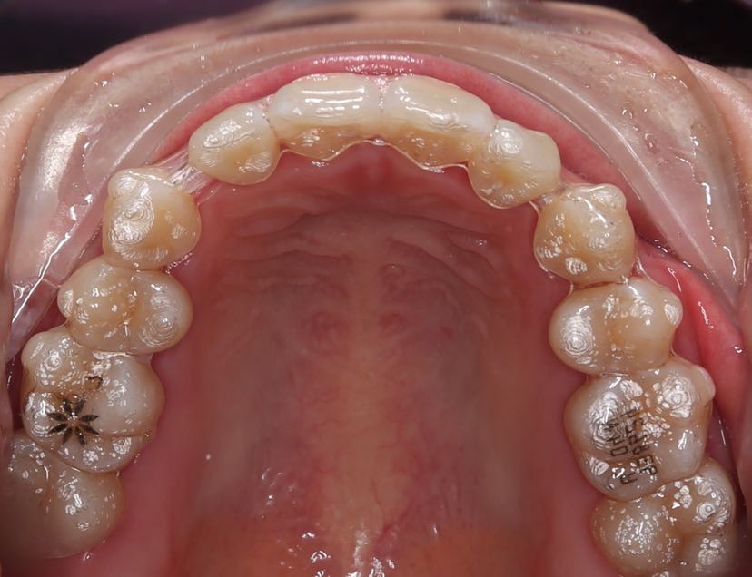 用手将隐形牙套就位后,拿住咬胶的一端,将另一端放入口中轻咬,从口腔