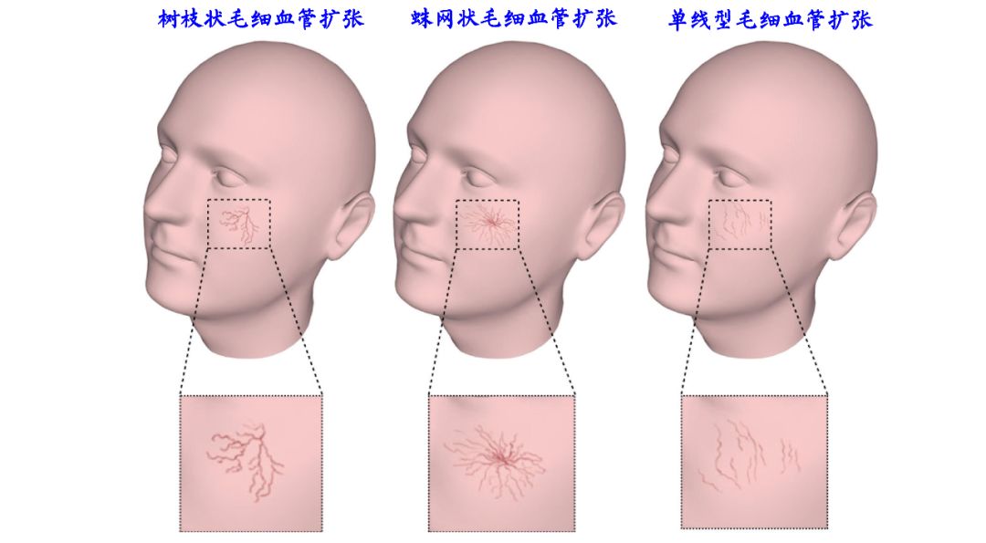 面部毛細血管擴張三種常見類型