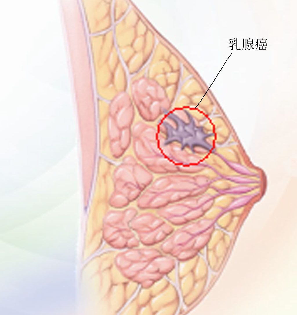乳腺癌.png