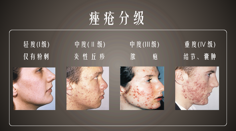 很多人就认为痤疮只是一个美容问题,不是皮肤疾病问题,所以相信美容院