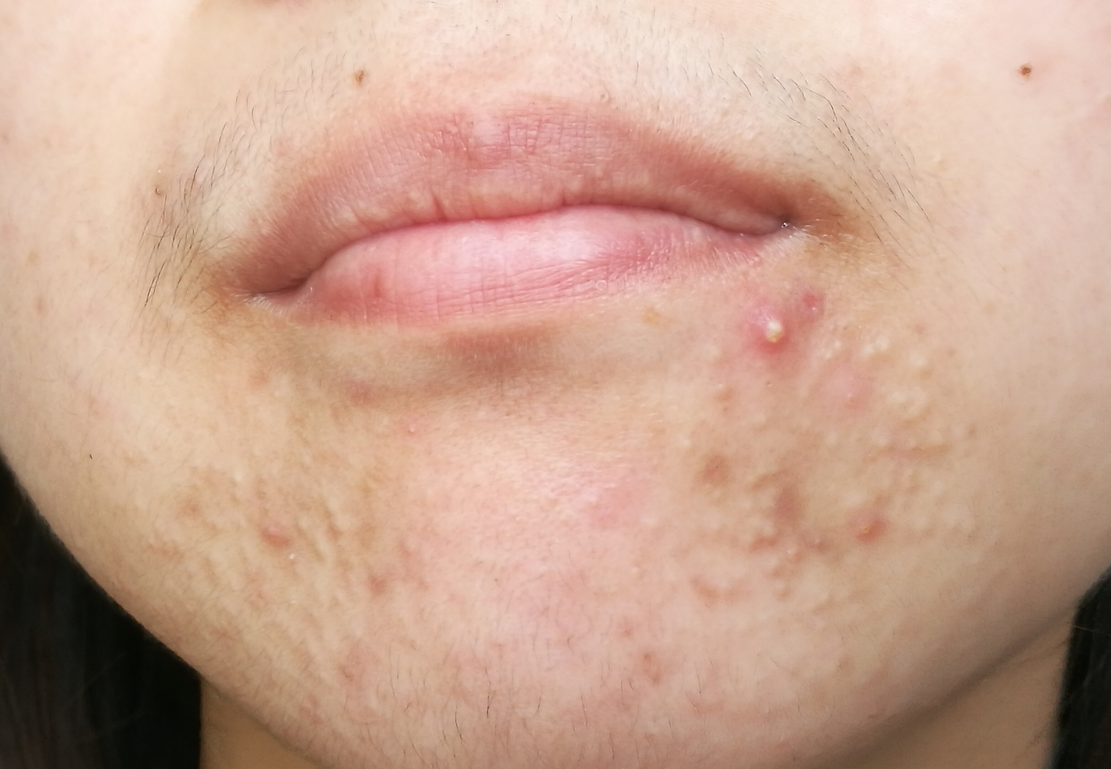 玫瑰痤疮长啥样-朱敏刚主任医师-爱问医生