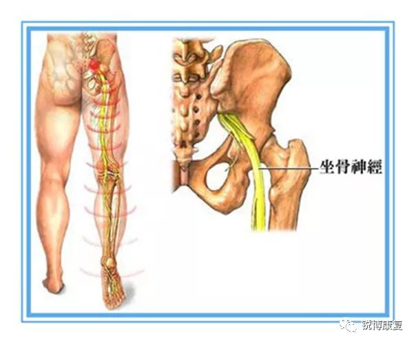 腰不好"腿"先麻?你的神经被压了!