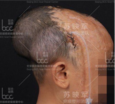 扩张器修复头部烫伤疤痕,让孩子重新"长"出头发