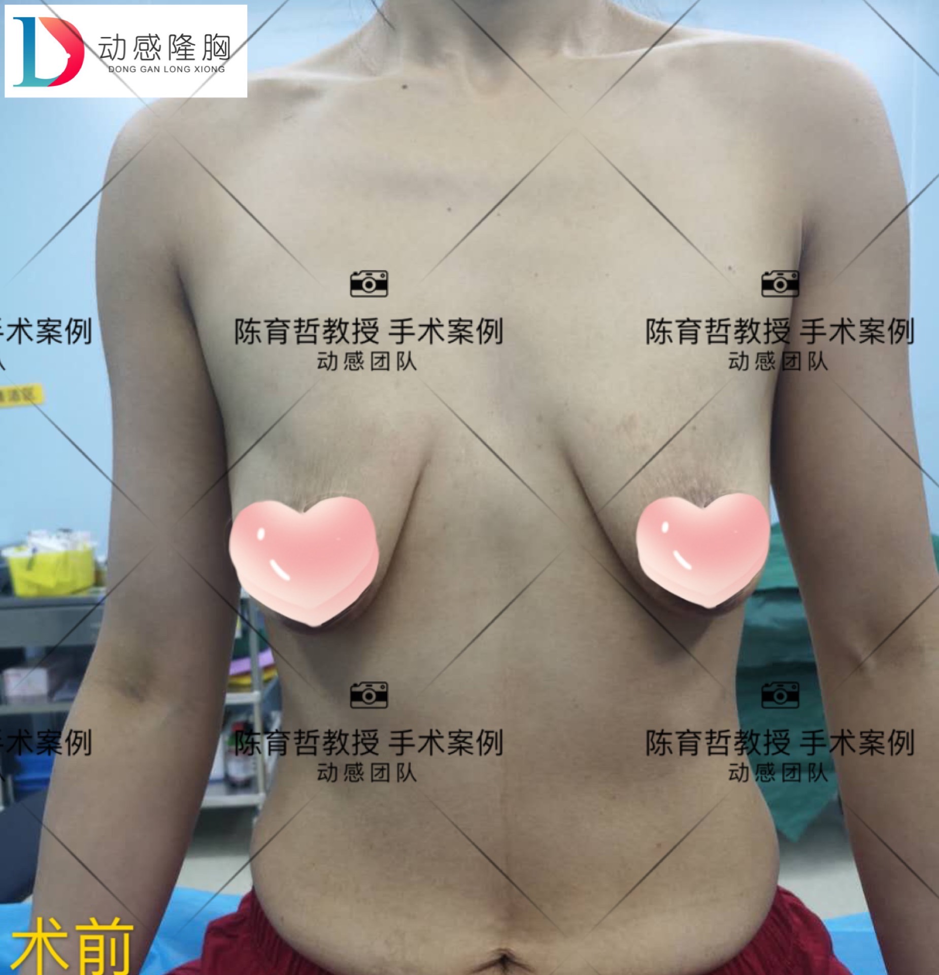 胸型不够美 怎么办呢 陈育哲副主任医师 爱问医生