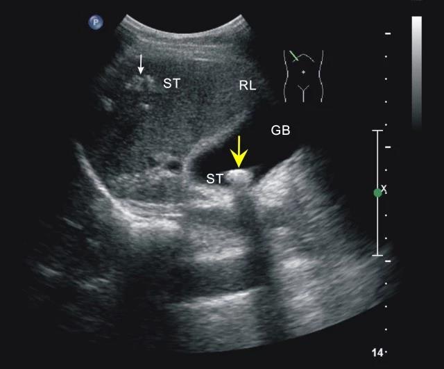 胆总管结石彩超图片图片