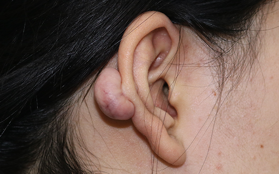 耳朵瘢痕疙瘩是怎么形成的?又该怎么解决呢?