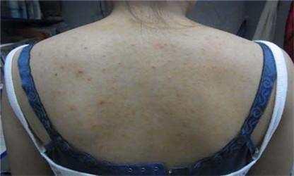 你的背后长小米粒吗