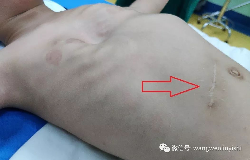 2岁半poland综合征患儿第5次手术:wang手术