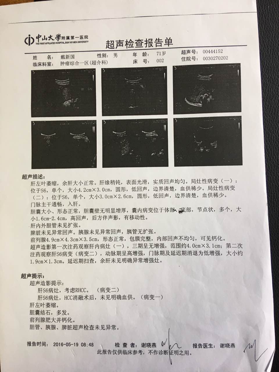 身患肝癌并伴有脑梗,心梗,治疗十个月创造生命奇迹!