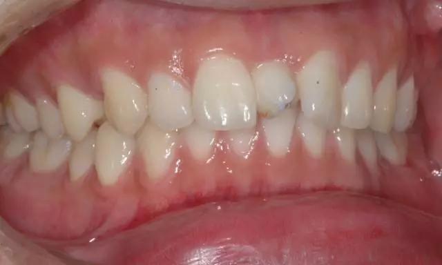 11恒牙不萌出或埋伏阻生阻生牙是指牙齿部分萌出或完全不能萌出,并且