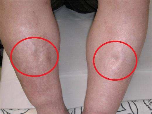 一个被酗酒耽误的肾脏病患者