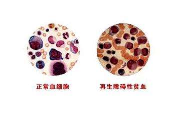 让再障患者避之唯恐不及的"感染",怎么预防?