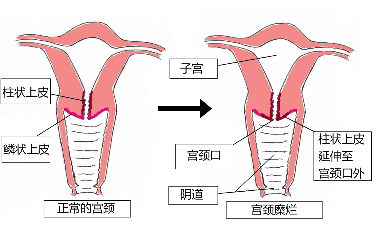 宫颈解剖位置示意图图片