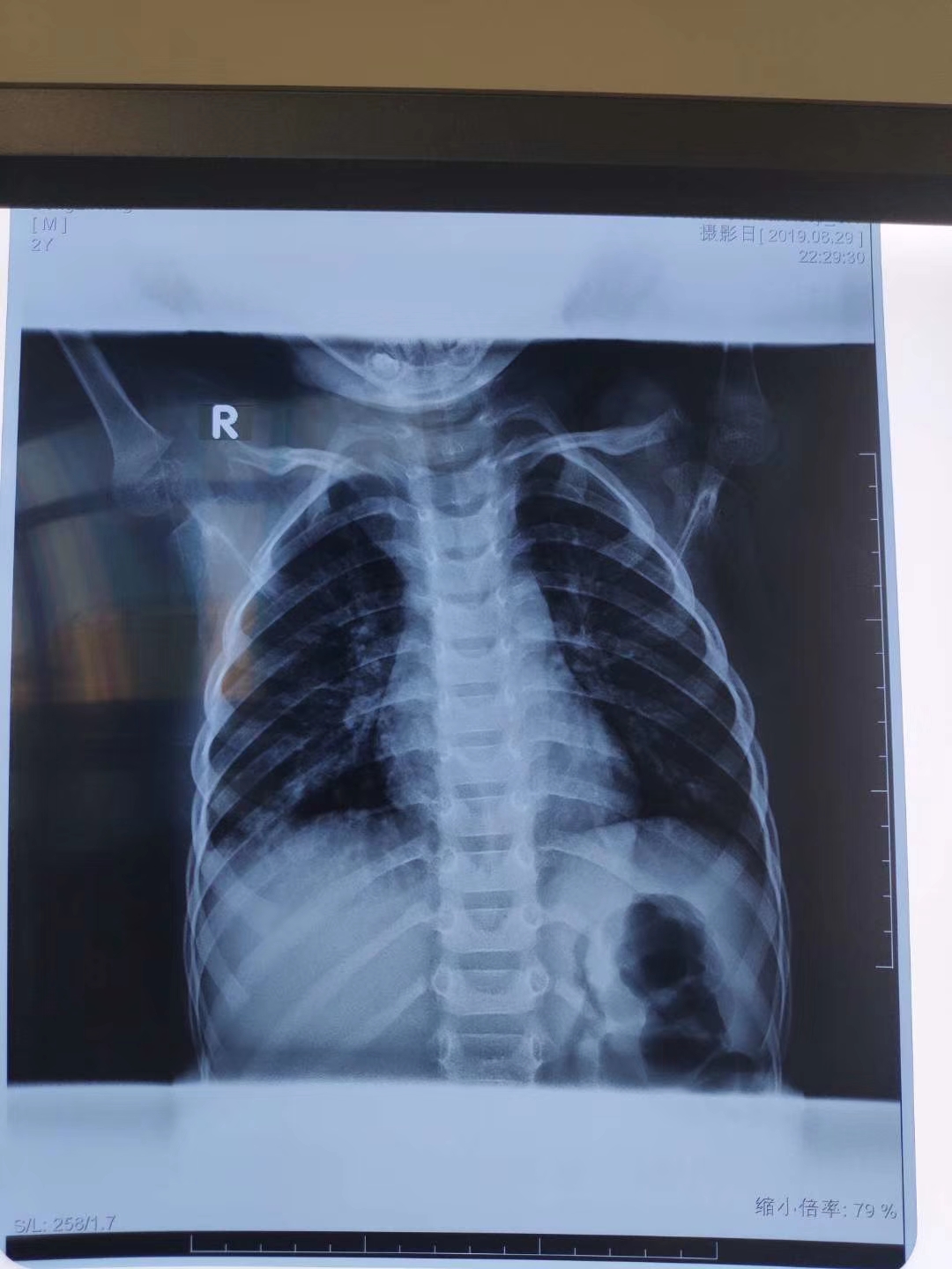 肺炎孩子胸片提示胸腔积液,但进一步检查却消失了?