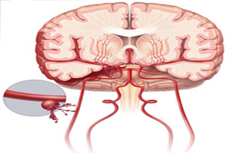 蛛網膜下腔出血是什麼情況?要怎麼處理?