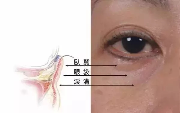 如果你早点知道这些事情,泪沟早就去掉了!