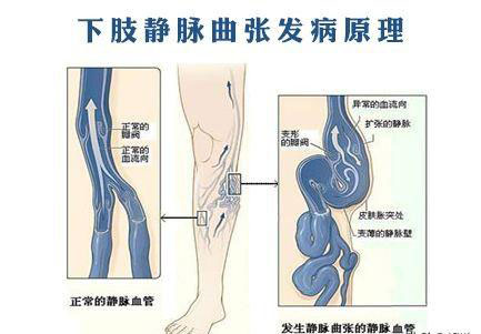 央视主持人踩机舱竟然为了治病,静脉曲张需要抬腿缓解病情吗?
