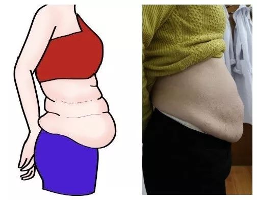 生完娃肚子收不回去?腹直肌分离惹的祸!