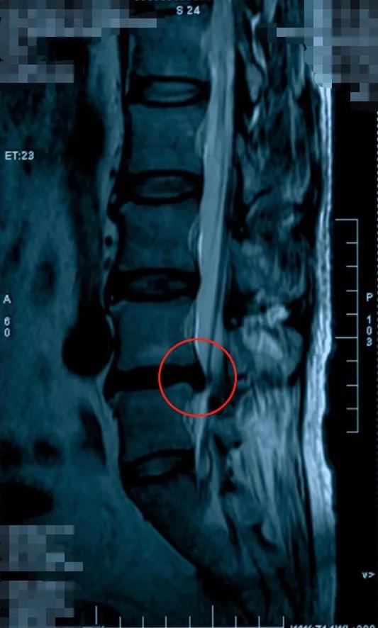 病例分享明明腰不痛怎么就腰椎间盘突出了呢