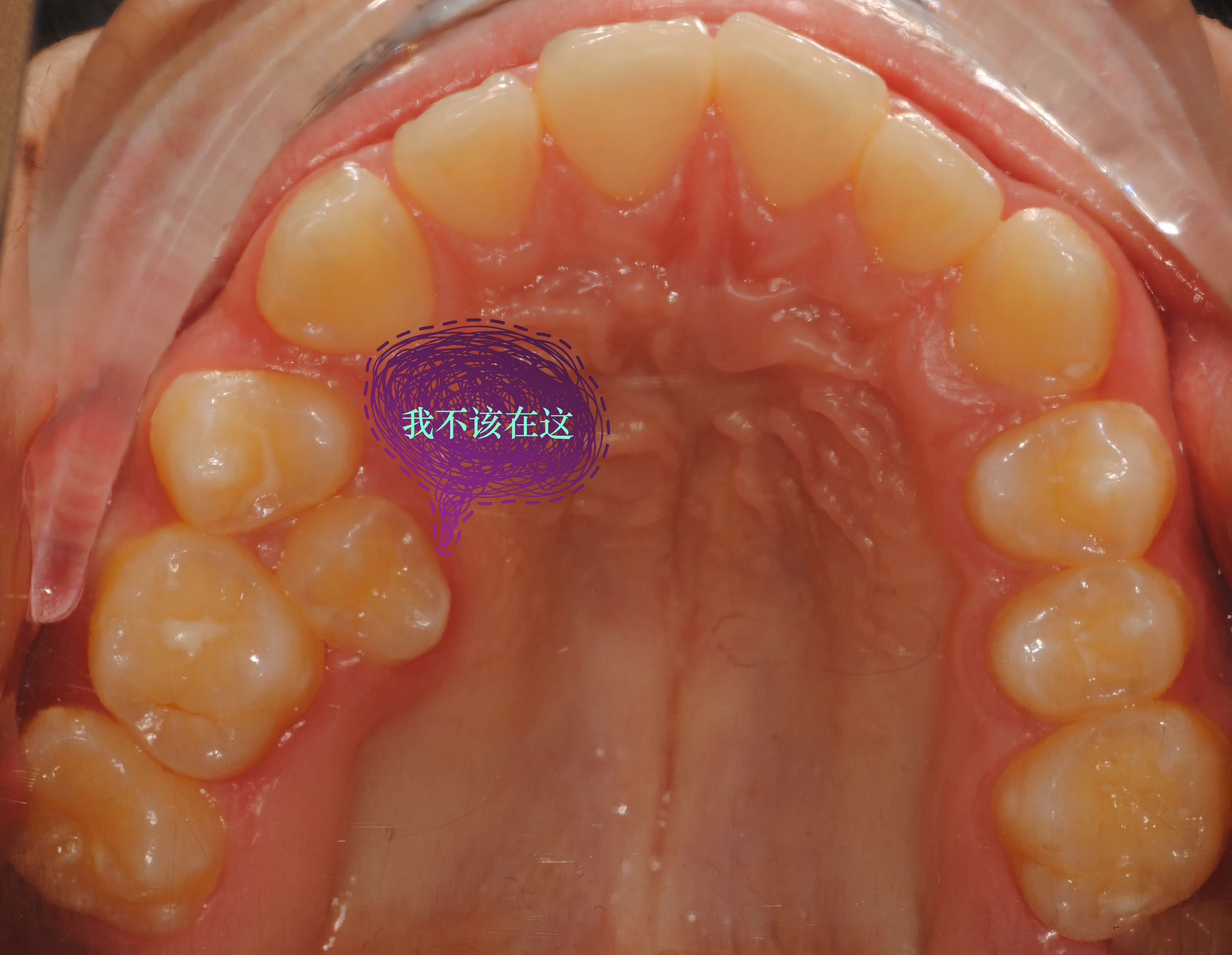 或恒牙上面有釉质钙化不良白斑或黄斑的或缺损,我在临床上经常能够