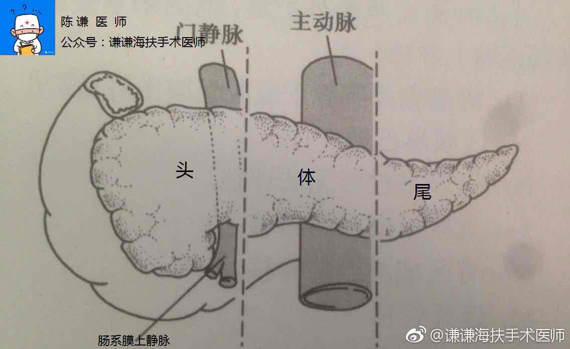 胰腺钩突癌图片