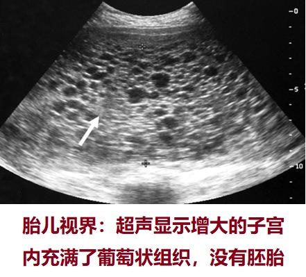 图五,腹部超声波检查完全性葡萄胎,子宫内没有胚胎 ( 图片来自于教材)