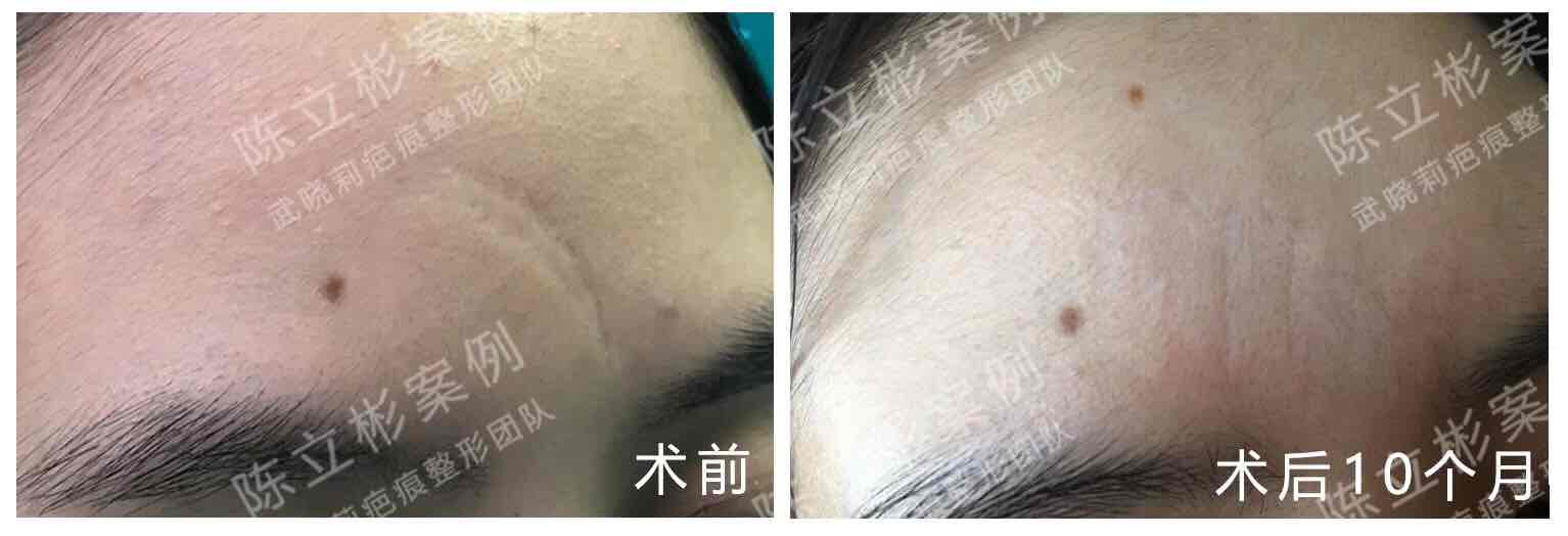 额部陈旧凹陷疤痕术后10月随访