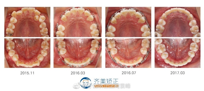 矫正拔牙,老了以后牙齿会松动吗?