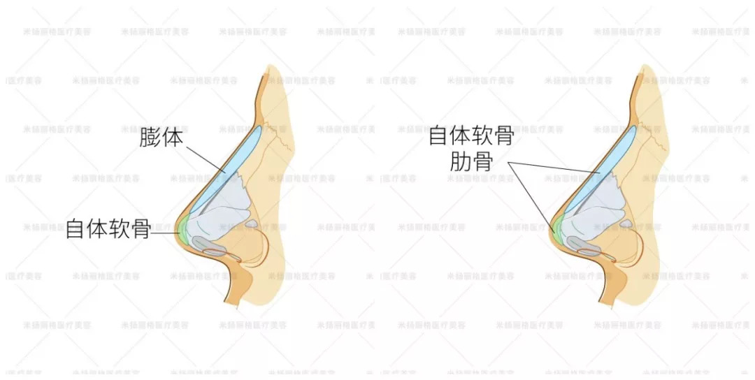 亚洲人隆鼻,鼻背为何优选膨体?