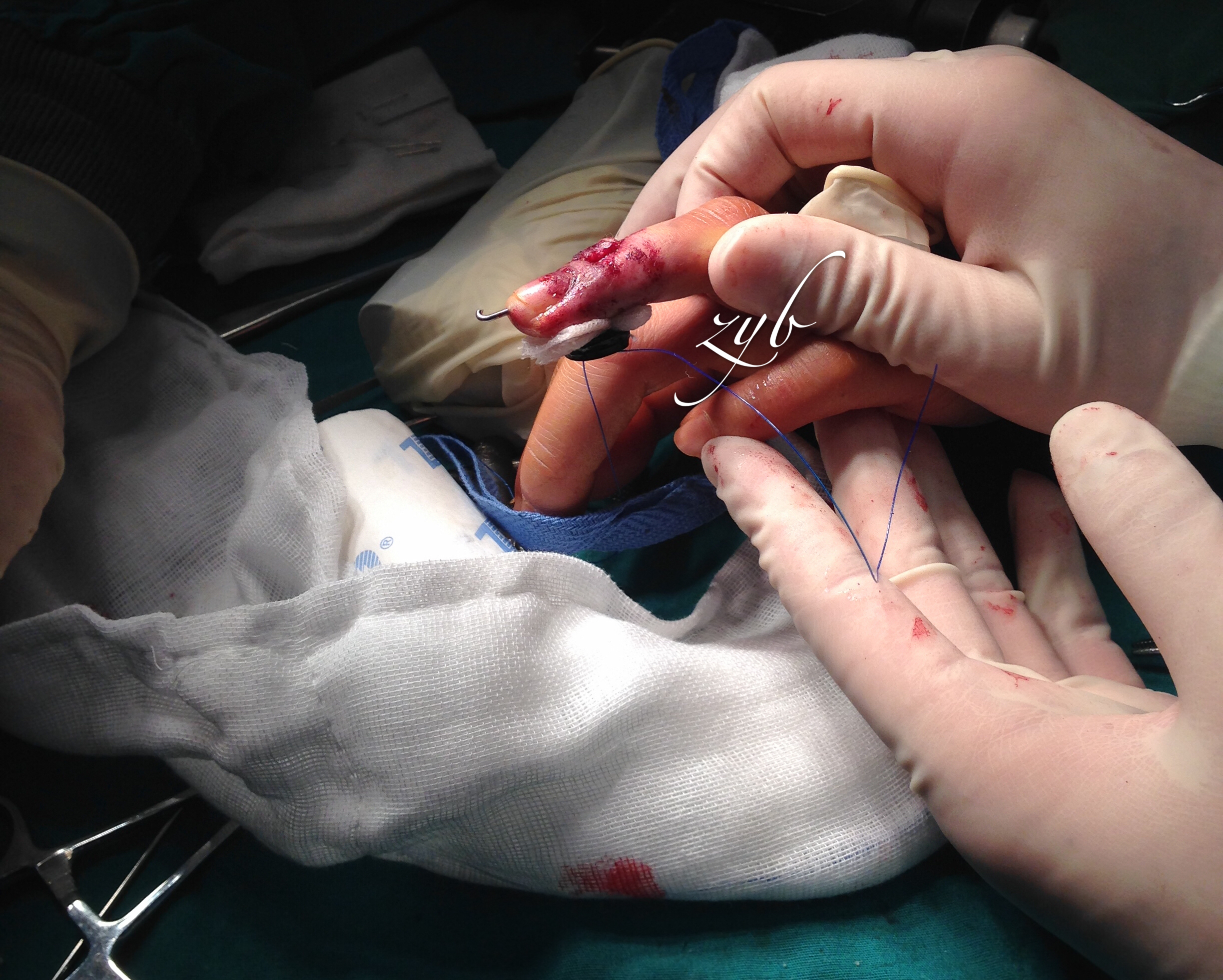 锤状指手术过程图片
