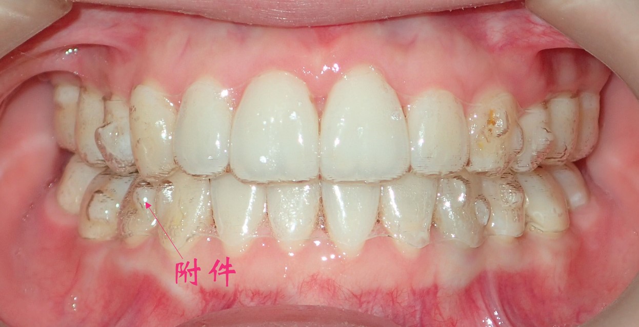 佩戴隐形牙套都有哪些注意事项?