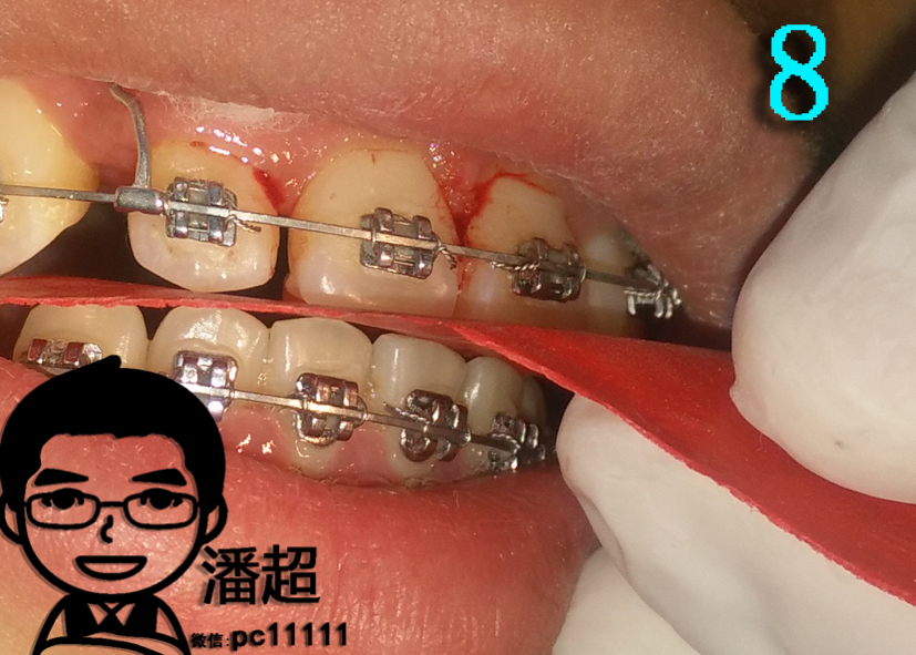 深覆合是啥?需不需矫正,附固定树脂平导制作过程