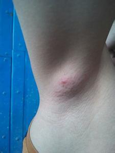 乳腺癌术后左侧腋窝出现淋巴结组方调理三月后结节消失