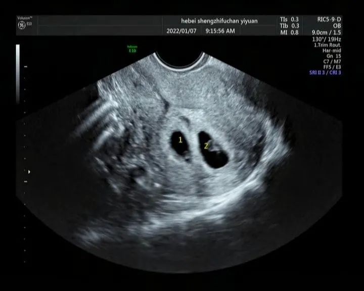 移植十八天胚胎图片图片