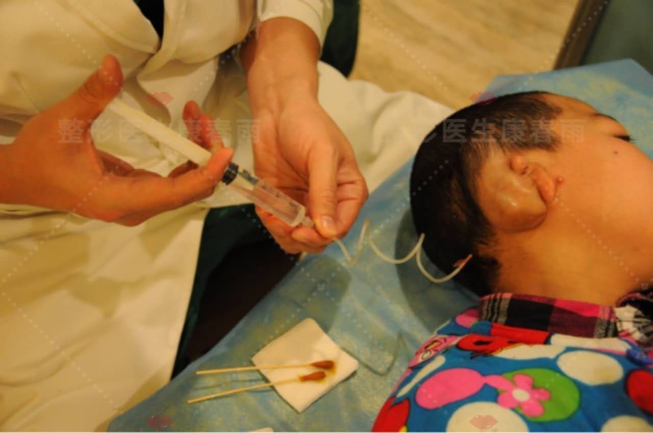 到时只需取出扩张器,切取自体肋软骨,并根据健侧的耳朵大小雕刻耳支架