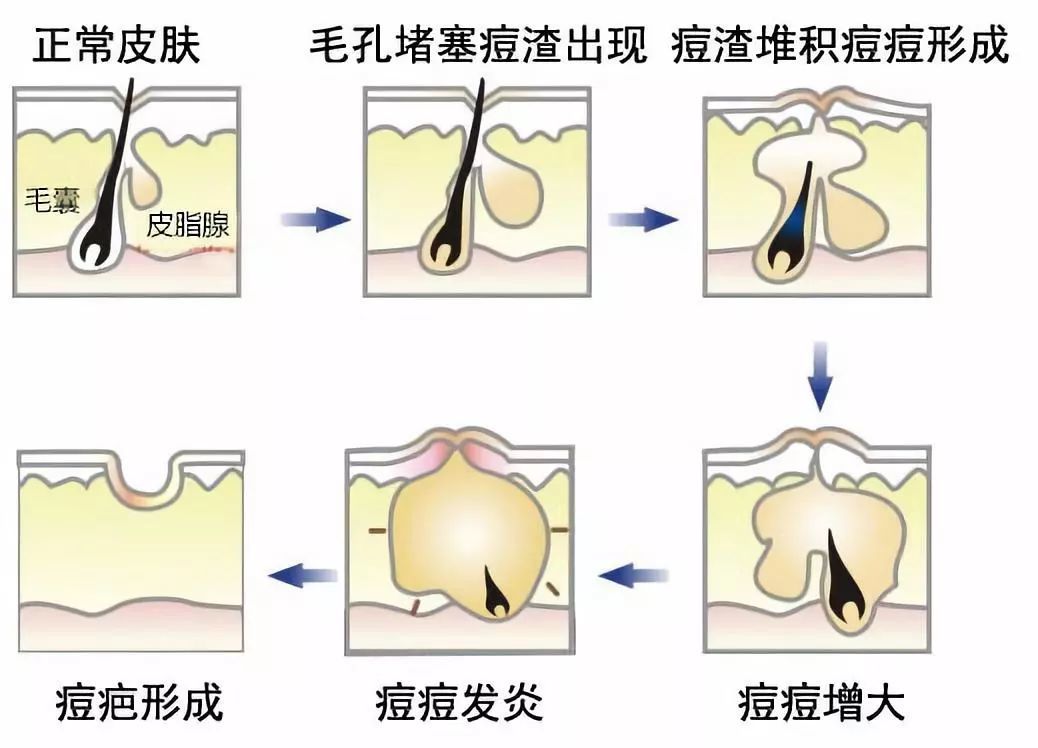 粉刺是怎么形成的图片图片