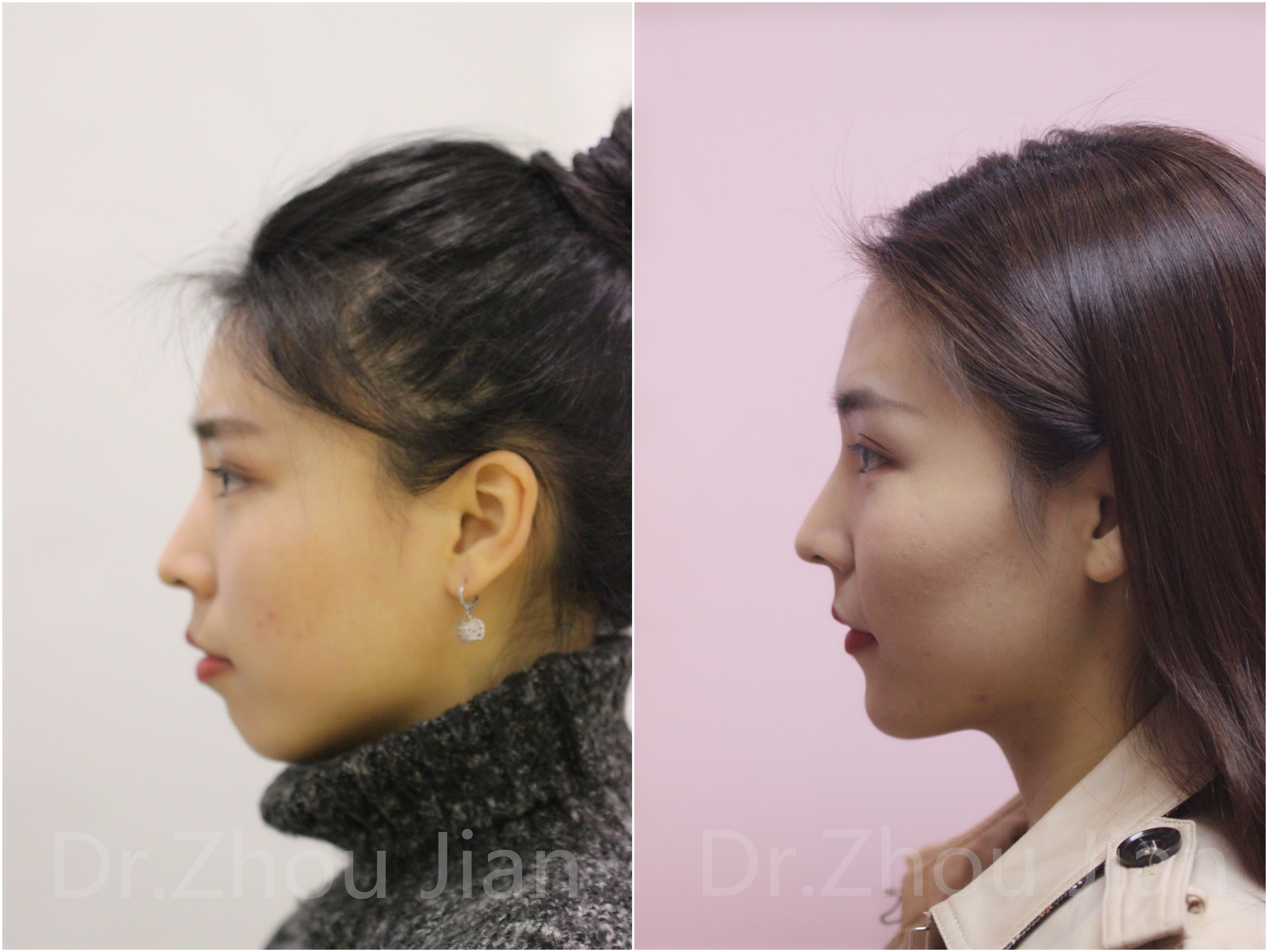 是不是正畸医生都不建议做正颌手术