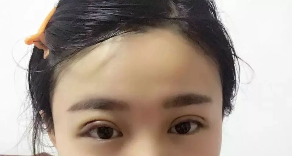 半年后双眼皮明显不对称