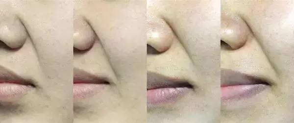 笑或不笑,鼻唇沟就在那里皮下组织老化下垂加深鼻唇沟大笑或大吃一惊