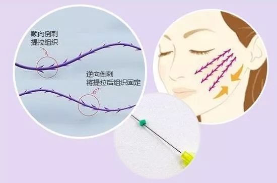 线雕埋线提升是什么有什么作用还有相关问题解答