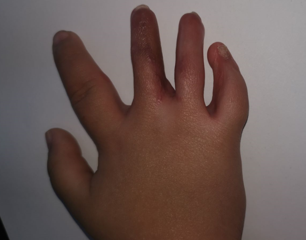 宝宝复杂并指治疗案例一