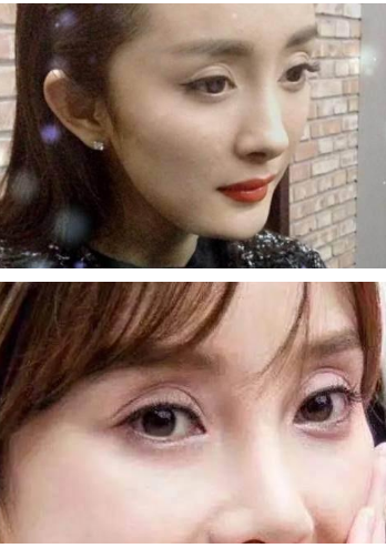 眼窝凹陷=深邃欧式双眼皮?no!