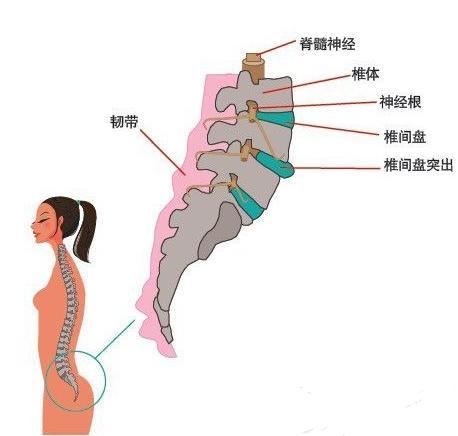 教你自我檢測腰椎間盤是否突出