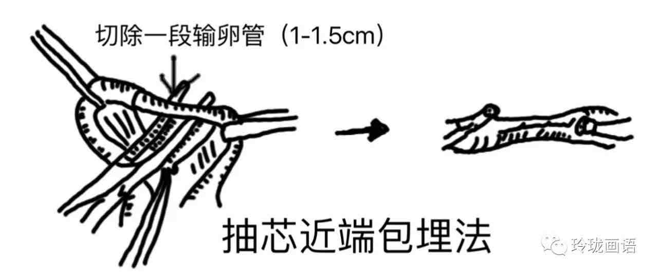 这种结扎方法简单,失败率在1.5%以内.输卵管绝育术是怎么做的?