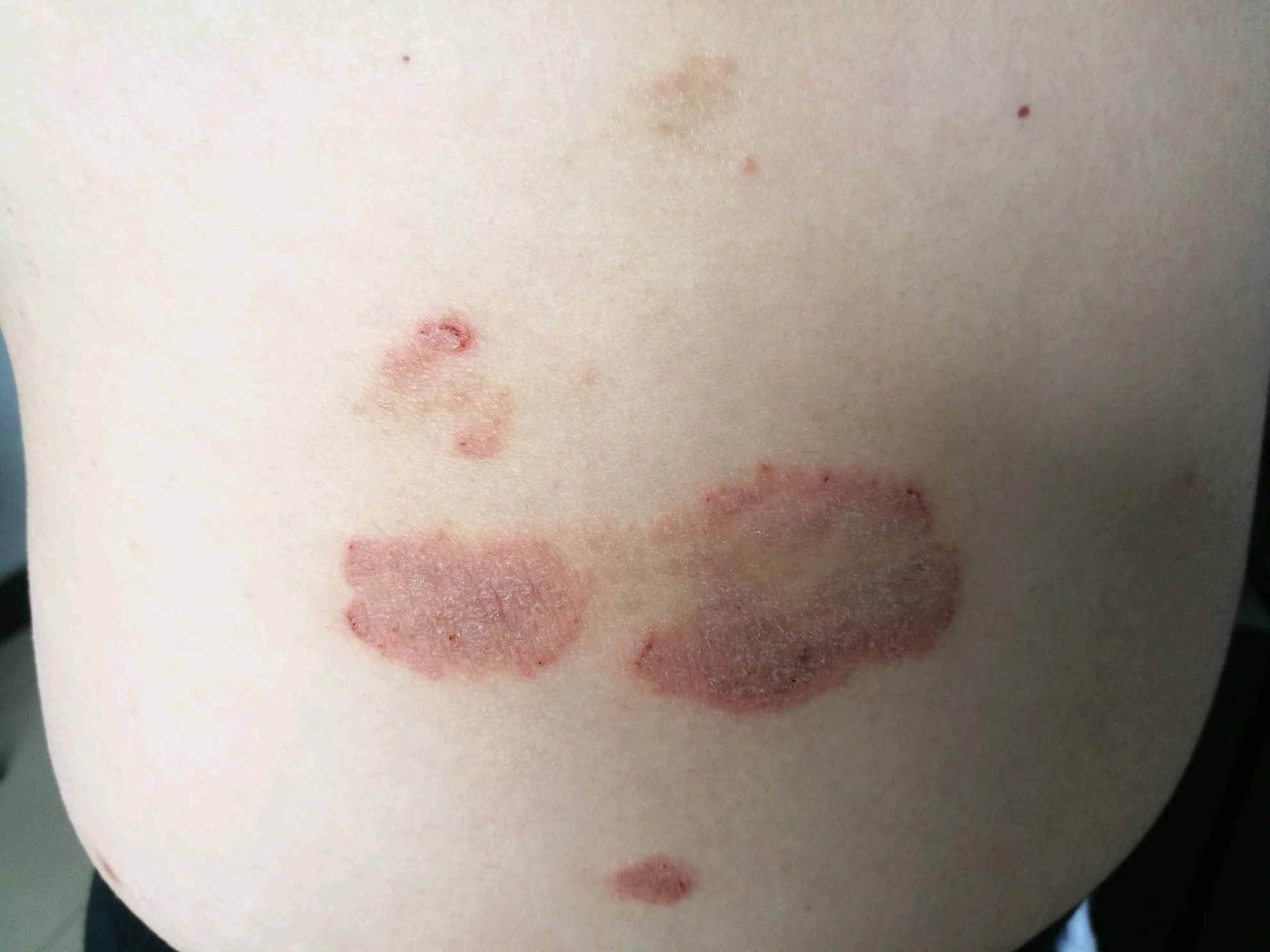 银屑病俗称牛皮癣,是常见的红斑鳞屑性皮肤病,没有传染性,但常常给