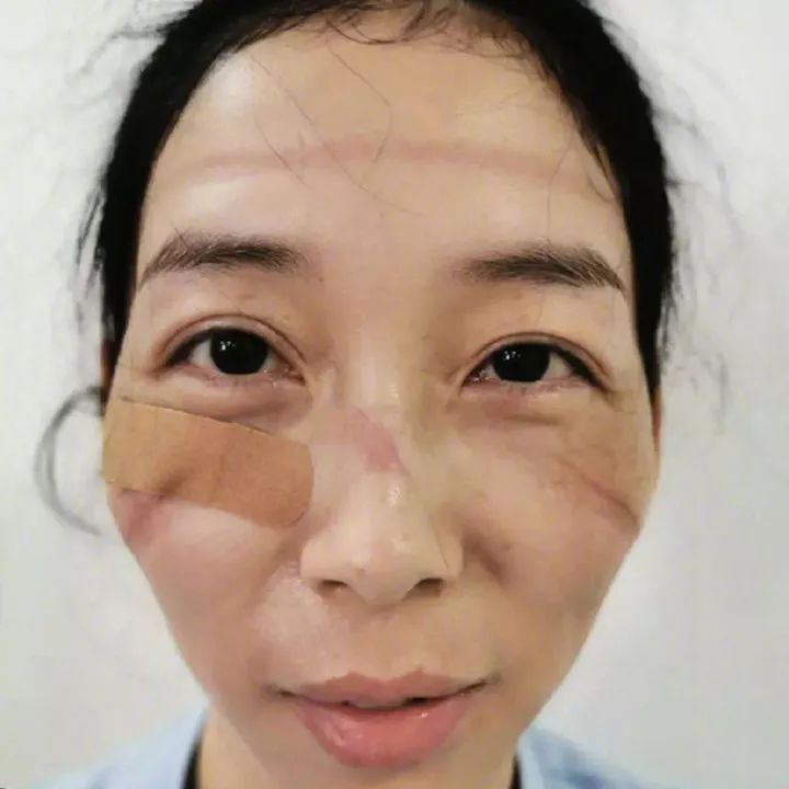 缓解口罩边缘对局部皮肤的压迫