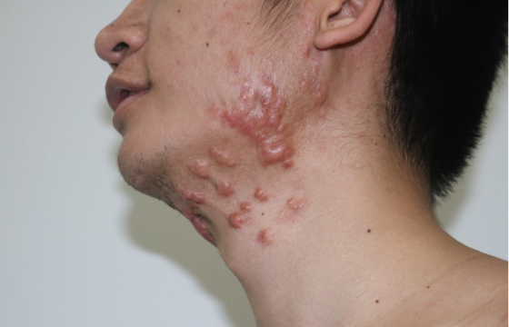 男 年龄:21岁 地区:云南省 病况:瘢痕疙瘩在双侧下颌,颈部,由于毛囊炎
